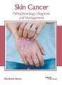 Skin Cancer: Pathophysiology, Diagnosis and Management (Hardcover): Elizabeth Burns