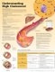 Understanding High Cholesterol Lam (Wallchart, Second, Laminated): Anatomical Chart Company